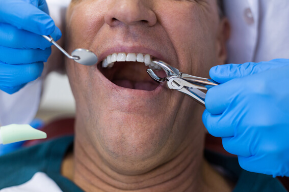 https://www.orafitdental.com/wp-content/uploads/2023/08/tooth-removal.jpg